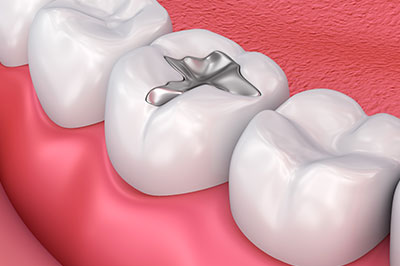 This is a digital illustration of an open human mouth showing multiple teeth with one prominently featuring a silver filling or crown.