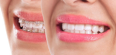 The image shows a woman with a wide smile, displaying her teeth and lips.