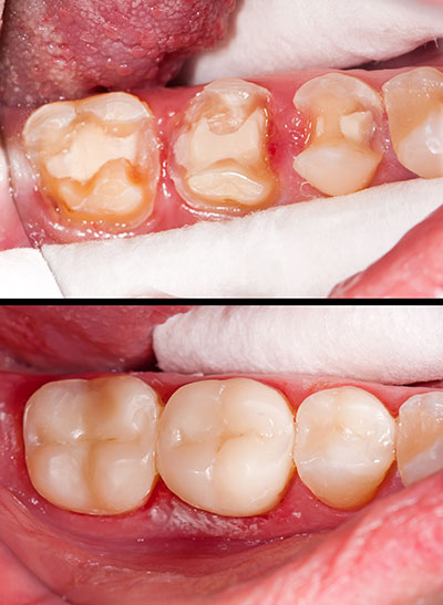 The image shows a close-up of a human mouth with teeth that appear to be in poor condition, possibly decayed or damaged, against a background that includes medical or dental equipment.