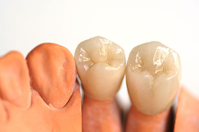 The image displays a set of artificial teeth and gums, showcasing the dental implant process with visible screws and a plastic model of a mouth.