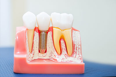 An image of a dental model with multiple teeth, some showing signs of decay or damage, placed on a pink plastic base, showcasing dental care tools and procedures.