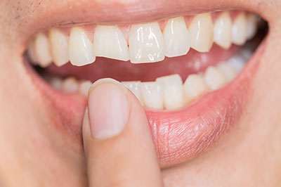 A person holding their finger in front of a close-up of their teeth, showcasing a dental implant.