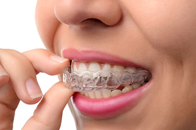 A person s smiling face with a clear aligner over their teeth.