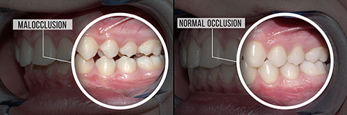 An image showing a side-by-side comparison of a mouth with teeth and gums, before and after an oral surgical procedure, labeled as  normal occlusion  and  malocclusion  respectively.