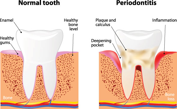 The image is a medical illustration showing the normal tooth structure, the progression of periodontitis with bone loss and gum pocket deepening, and a cross-sectional view of a healthy tooth and a diseased tooth affected by periodontitis.