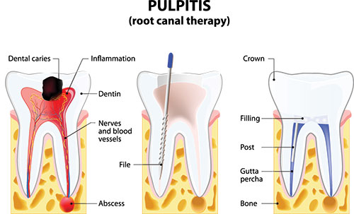 The image is a detailed medical illustration showing the anatomy of a human tooth, including its root canal therapy and dental caries.