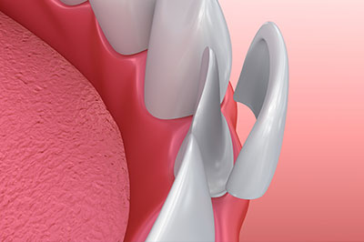 A 3D rendering of a dental implant with a screw-like design, set against a red background.