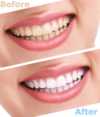 The image shows a side-by-side comparison of a person s teeth before and after dental treatment, emphasizing the improvement in whiteness and possibly straightness.