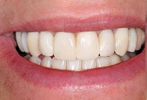 The image shows a close-up of a person s smiling mouth with white teeth, set against the background of their face.