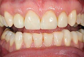 The image shows a close-up of a person s teeth, with visible signs of tooth decay and discoloration.