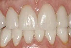 The image shows a close-up of a person s teeth, with the focus on a set of upper front teeth that appear to be in need of cosmetic dental work due to discoloration and uneven spacing.