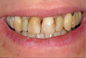 A close-up of a person s smile with yellowed teeth and visible signs of dental decay.