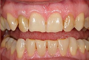 An image of a close-up view of a person s teeth, showing yellow staining and some decay, with the focus on dental care or oral health issues.