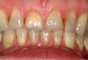 The image shows a close-up of a person s teeth with visible staining, suggesting the need for dental care or treatment.