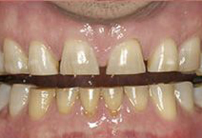 The image shows a close-up of a person s mouth with crooked teeth and visible staining, likely due to tobacco use.
